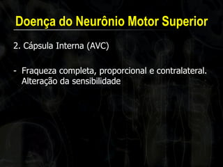 Doença do Neurônio Motor Superior 
2. Cápsula Interna (AVC) 
-Fraqueza completa, proporcional e contralateral. Alteração da sensibilidade  