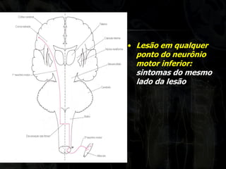 •Lesão em qualquer ponto do neurônio motor inferior: sintomas do mesmo lado da lesão  