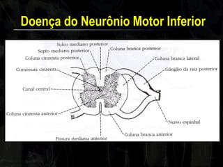 Doença do Neurônio Motor Inferior 
 