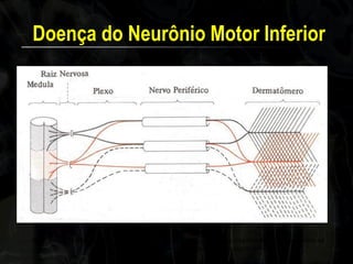 Doença do Neurônio Motor Inferior 
As raízes que formam os plexos dividem-se em nervos periféricos que se dispõem de forma segmentar na pele (dermatômeros). Observe a superposição dos segmentos.  