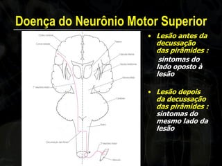 Doença do Neurônio Motor Superior 
•Lesão antes da decussação das pirâmides : 
sintomas do lado oposto à lesão 
•Lesão depois da decussação das pirâmides : sintomas do mesmo lado da lesão  