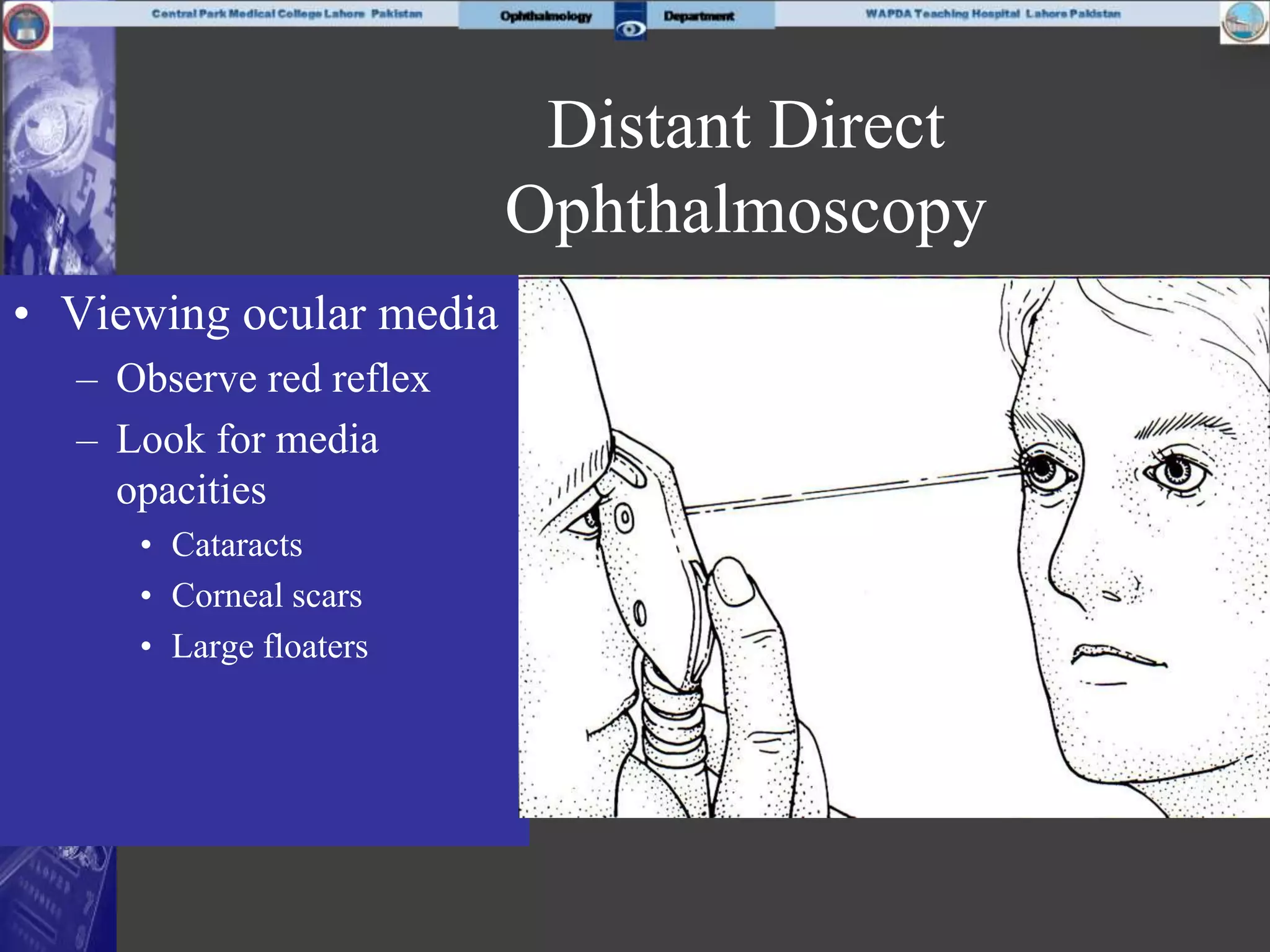 Distant Direct
Ophthalmoscopy
• Viewing ocular media
– Observe red reflex
– Look for media
opacities
• Cataracts
• Corneal scars
• Large floaters
 