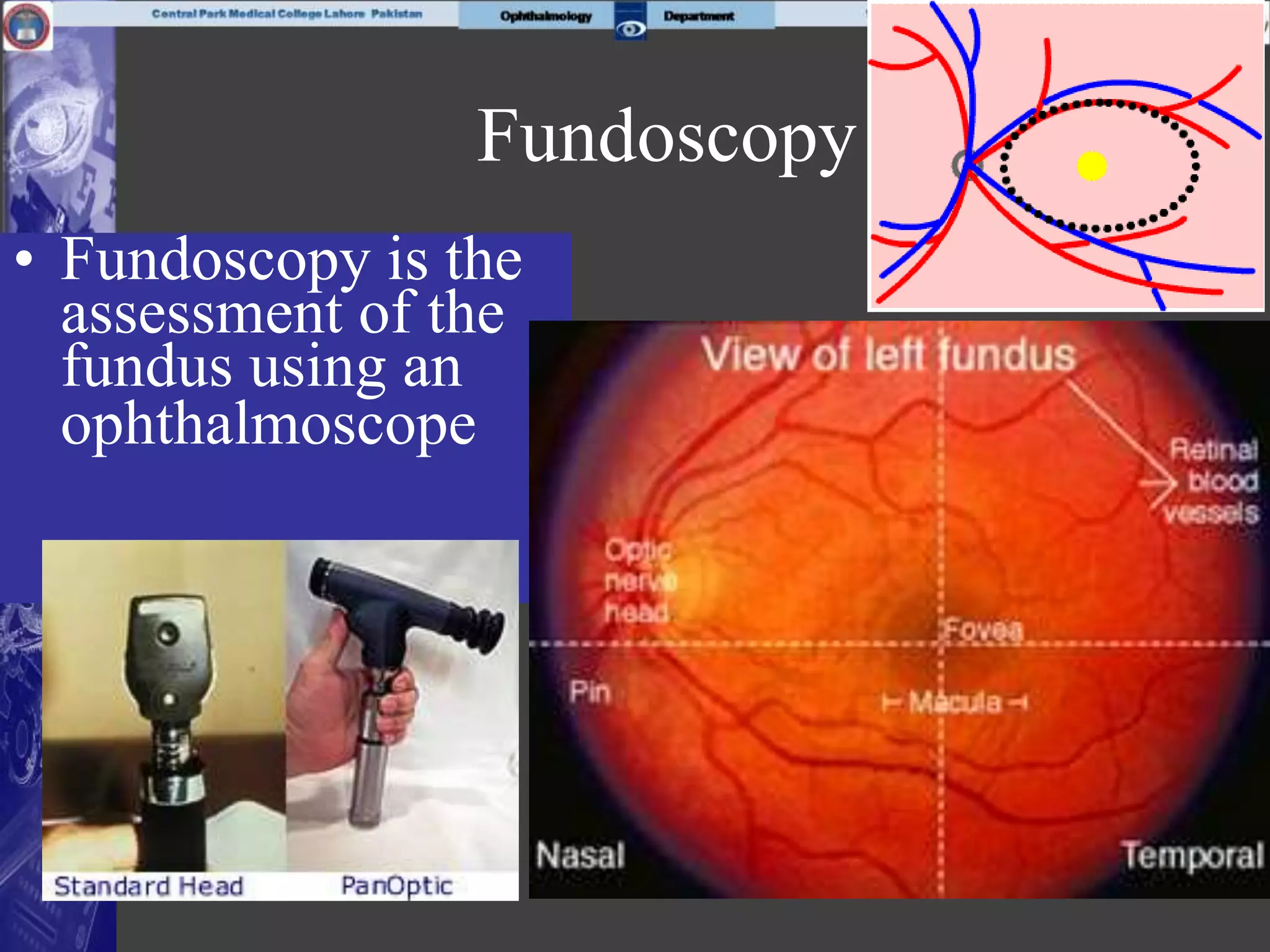 Fundoscopy
• Fundoscopy is the
assessment of the
fundus using an
ophthalmoscope
 