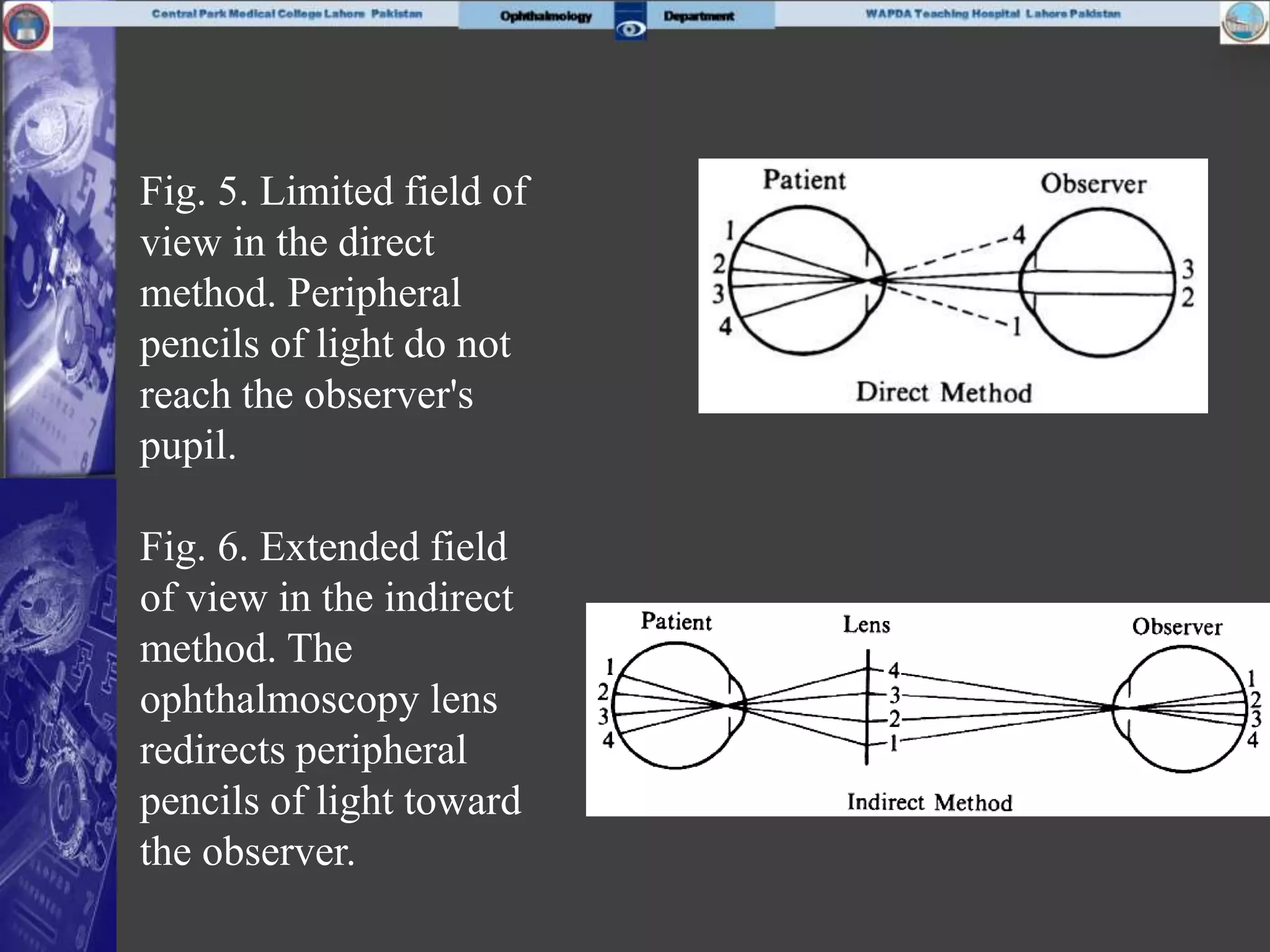 Fig. 5. Limited field of
view in the direct
method. Peripheral
pencils of light do not
reach the observer's
pupil.
Fig. 6. Extended field
of view in the indirect
method. The
ophthalmoscopy lens
redirects peripheral
pencils of light toward
the observer.
 