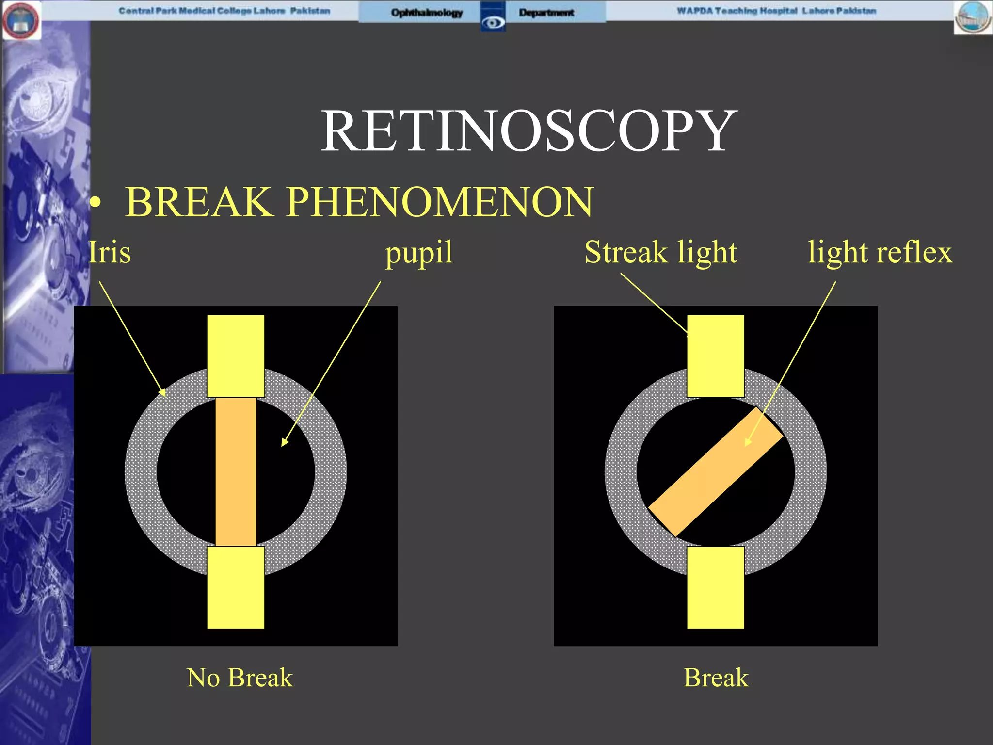• BREAK PHENOMENON
Iris pupil Streak light light reflex
No Break Break
RETINOSCOPY
 