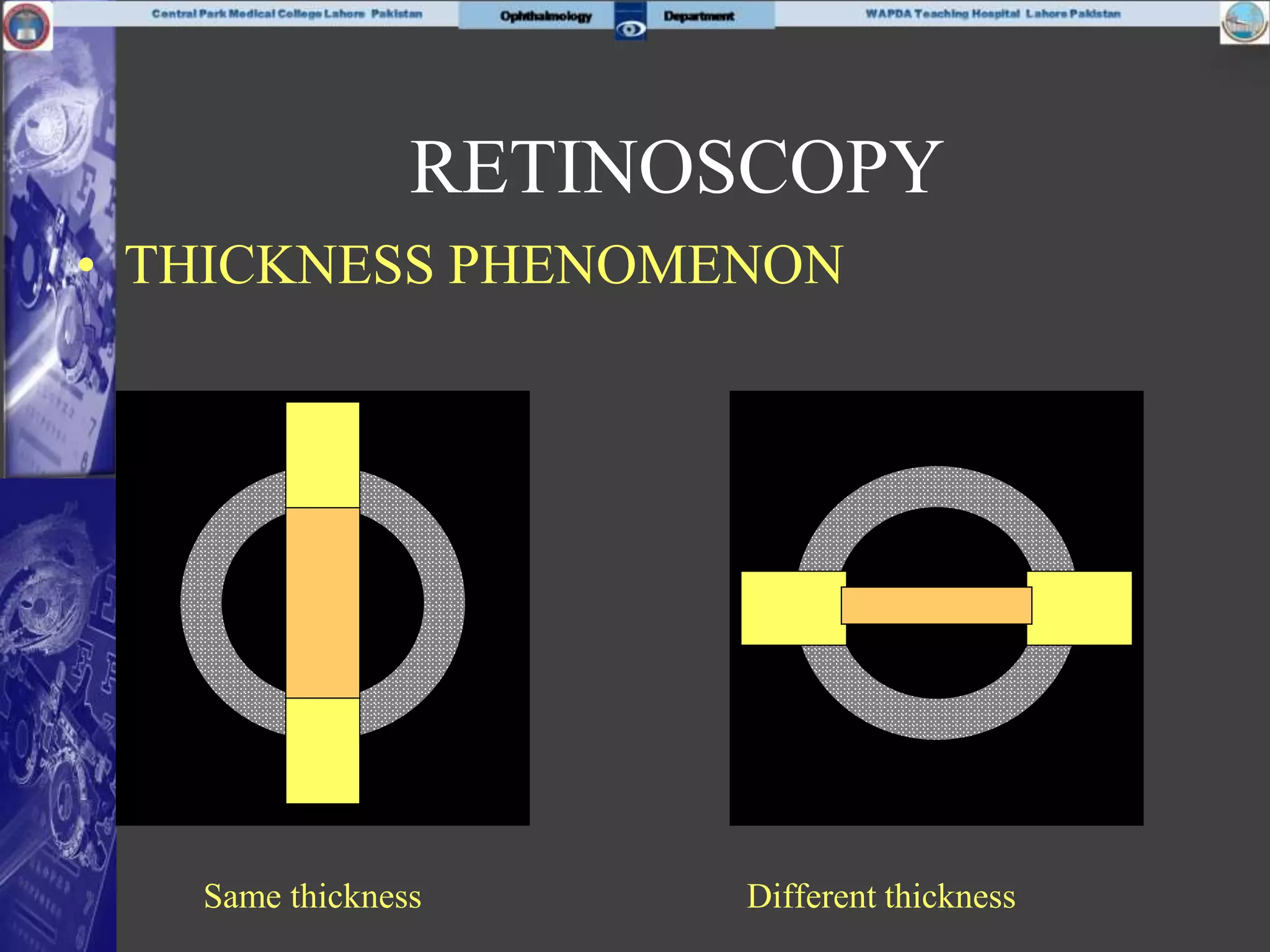 • THICKNESS PHENOMENON
Same thickness Different thickness
RETINOSCOPY
 