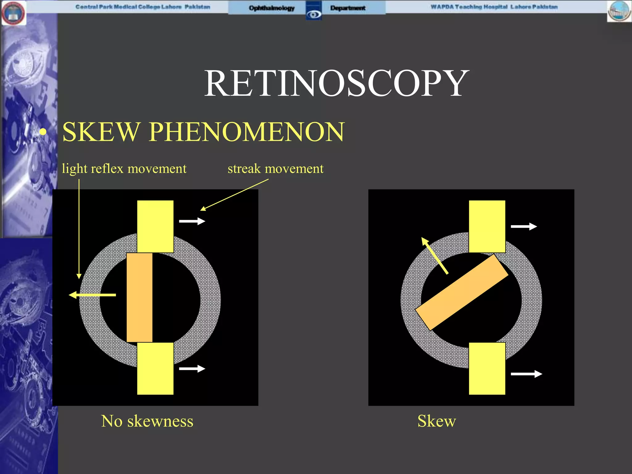 • SKEW PHENOMENON
light reflex movement streak movement
No skewness Skew
RETINOSCOPY
 