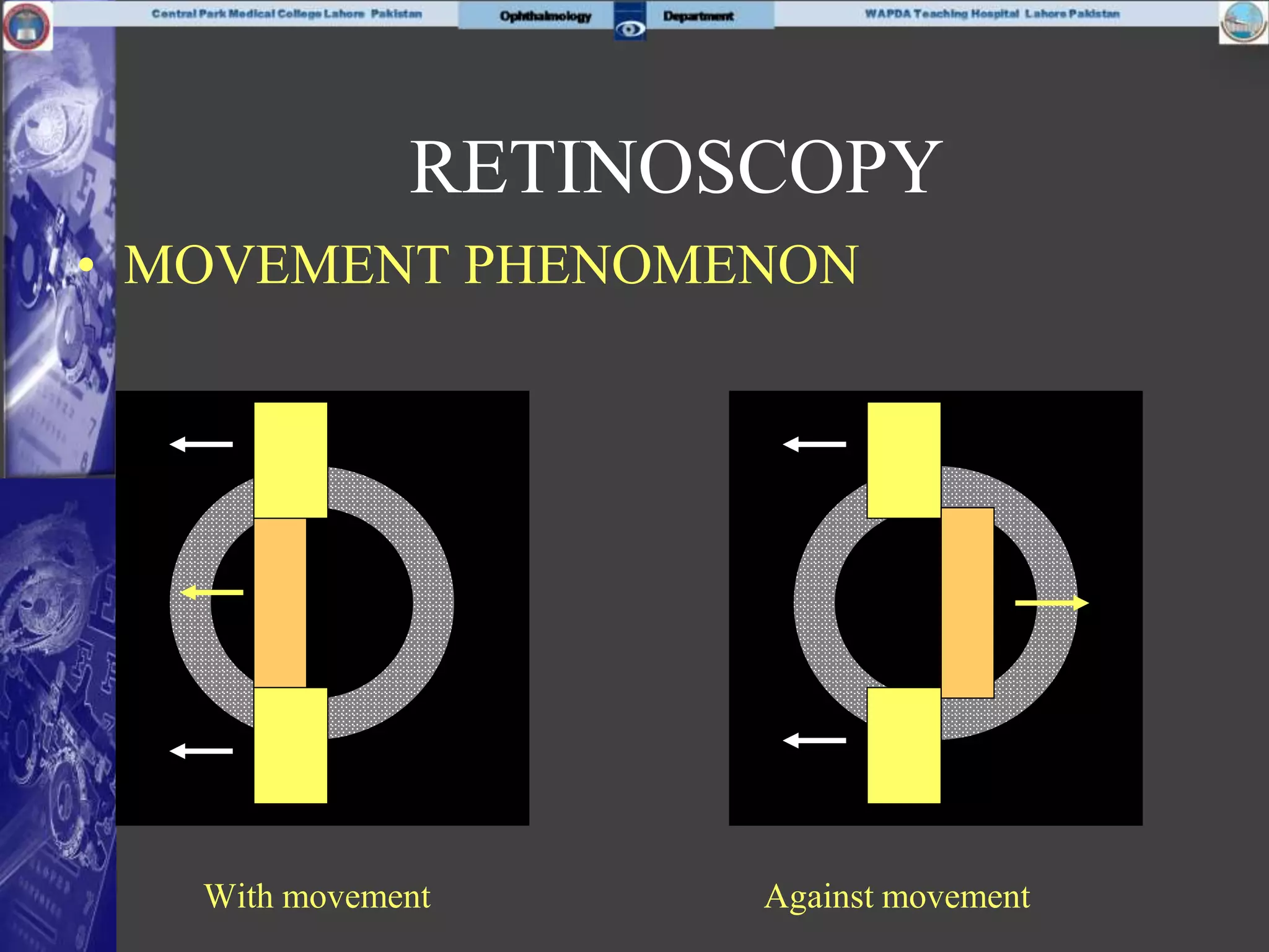 • MOVEMENT PHENOMENON
With movement Against movement
RETINOSCOPY
 