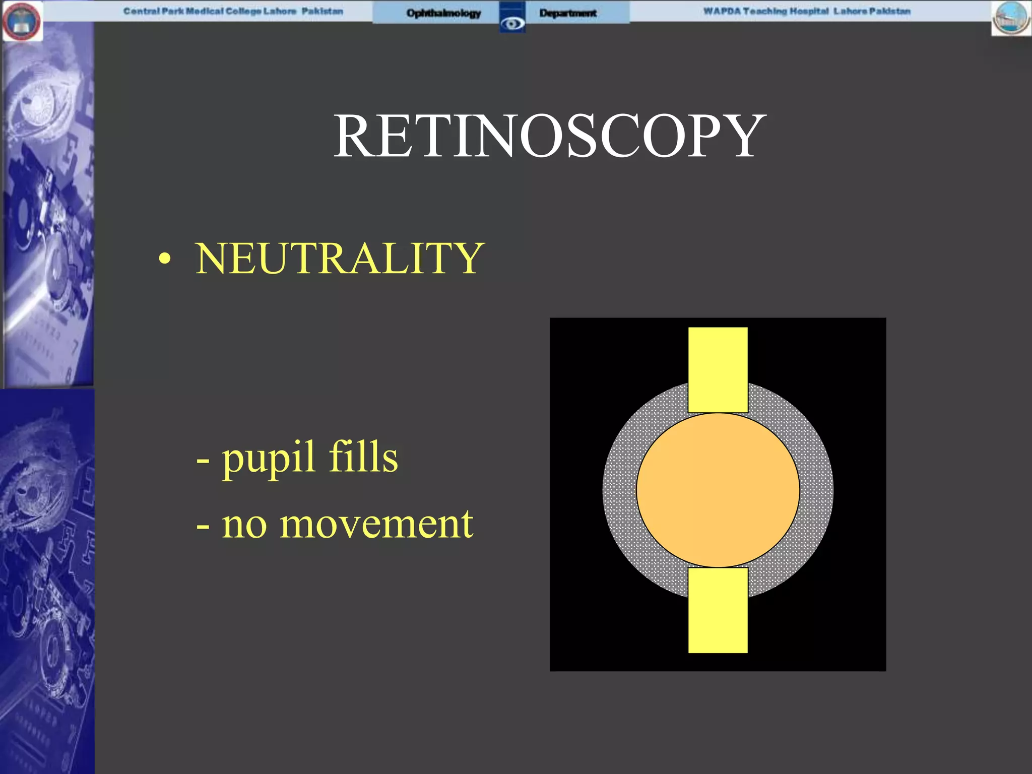 • NEUTRALITY
- pupil fills
- no movement
RETINOSCOPY
 