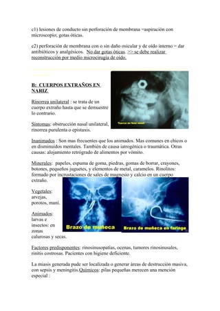 c1) lesiones de conducto sin perforación de membrana =aspiración con
microscopio; gotas óticas.
c2) perforación de membrana con o sin daño osicular y de oído interno = dar
antibióticos y analgésicos. No dar gotas óticas. >> se debe realizar
reconstrucción por medio microcirugía de oído.
.............................................................................................................................
...............
B: CUERPOS EXTRAÑOS EN
NARIZ
Rinorrea unilateral : se trata de un
cuerpo extraño hasta que se demuestre
lo contrario.
Síntomas: obstrucción nasal unilateral,
rinorrea purulenta o epistaxis.
Inanimados : Son mas frecuentes que los animados. Mas comunes en chicos o
en disminuidos mentales. También de causa iatrogénica o traumática. Otras
causas: alojamiento retrógrado de alimentos por vómito.
Minerales: papeles, espuma de goma, piedras, gomas de borrar, crayones,
botones, pequeños juguetes, y elementos de metal, caramelos. Rinolitos:
formado por incrustaciones de sales de magnesio y calcio en un cuerpo
extraño.
Vegetales:
arvejas,
porotos, maní.
Animados:
larvas e
insectos: en
zonas
calurosas y secas.
Factores predisponentes: rinosinusopatías, ocenas, tumores rinosinusales,
rinitis costrosas. Pacientes con higiene deficiente.
La miasis generada pude ser localizada o generar áreas de destrucción masiva,
con sepsis y meningitis.Químicos: pilas pequeñas merecen una mención
especial :
 