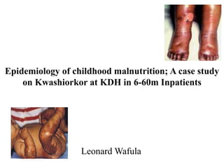 Epidemiology of childhood malnutrition; A case study
on Kwashiorkor at KDH in 6-60m Inpatients
Leonard Wafula
 