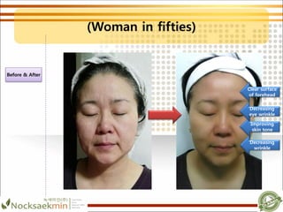 (Woman in fifties)
Improving
skin tone
Decreasing
wrinkle
Clear surface
of forehead
Decreasing
eye wrinkle
Before & After
 