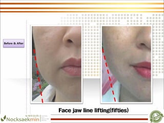 Face jaw line lifting(fifties)
Before & After
 