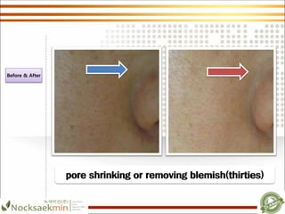 pore shrinking or removing blemish(thirties)
Before & After
 