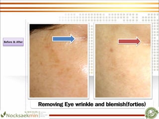 Removing Eye wrinkle and blemish(forties)
Before & After
 