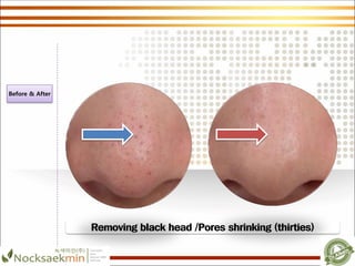 Removing black head /Pores shrinking (thirties)
Before & After
 