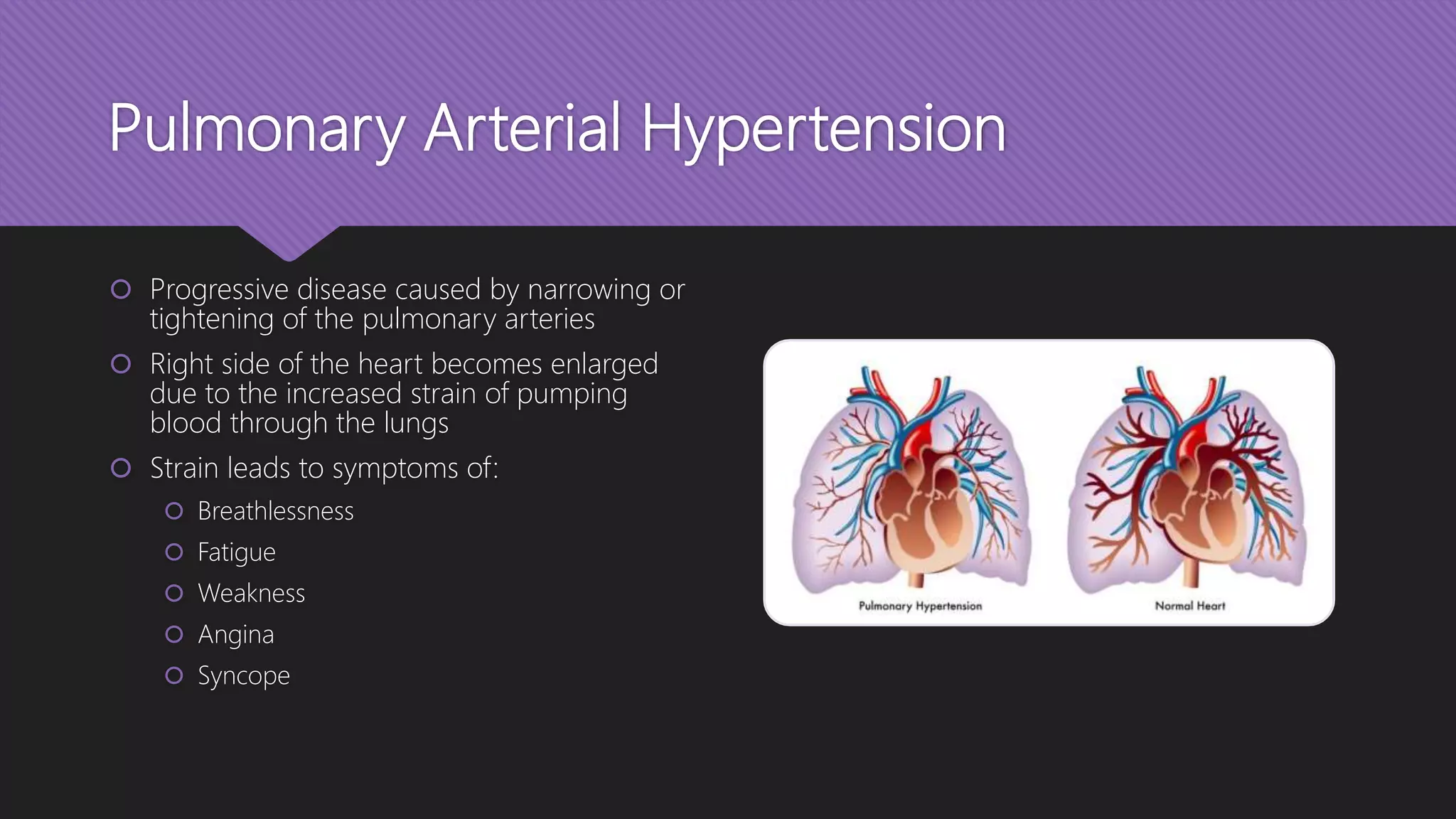 Pulmonary Arterial Hypertension
 Progressive disease caused by narrowing or
tightening of the pulmonary arteries
 Right side of the heart becomes enlarged
due to the increased strain of pumping
blood through the lungs
 Strain leads to symptoms of:
 Breathlessness
 Fatigue
 Weakness
 Angina
 Syncope
 