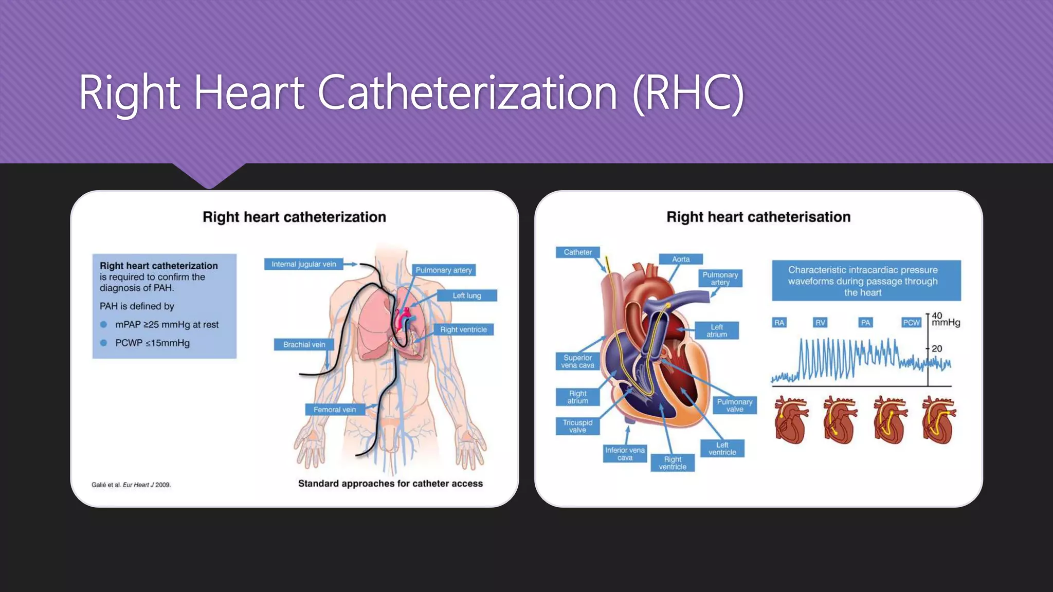 Right Heart Catheterization (RHC)
 