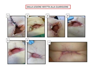 1 2 3 4
5 6
7
DALLA LESIONE INFETTA ALLA GUARIGIONE
 
