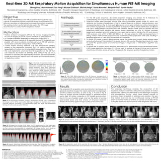 Real-time 3D MR Respiratory Motion Acquisition for Simultaneous Human PET-MR Imaging
Liheng Guo1, Mark Ahlman3, Tao Feng2, Michael Guttman4, Elliot McVeigh1, David Bluemke3, Benjamin Tsui2, Daniel Herzka1
1Biomedical Engineering, Johns Hopkins University, Baltimore, MD. 2Russell H. Morgan Department of Radiology and Radiological Science, Johns Hopkins University, Baltimore, MD.
3Radiology and Imaging Sciences, National Institutes of Health, Bethesda, MD. 4Cardiology, School of Medicine, Johns Hopkins University, Baltimore, MD.
References
1.  Koesters, et al. Motion-compensated EM PET Reconstruction for Simultaneous PET-MR Exams. ISMRM 2014 0789.
2.  Kolbitsch, et al. A 3D MR-acquisition scheme for non-rigid bulk motion correction in simultaneous PET-MR. ISMRM 2014 0788.
3.  Huang, et al. A Novel Golden-Angle Radial FLASH Motion-Estimation Sequence for Simult. Thoracic PET-MR. ISMRM 2013 2684.
4.  Kolbitsch, et al. T1 and T2 Weighted MR Acquisition for Bulk Motion Correction for Simultaneous PET-MR. ISMRM 2013 3745.
5.  Grimm, et al. MR-PET Respiration Compensation Using Self-Gated Motion Modeling. ISMRM 2013 0829.
6.  Fürst, et al. Respiratory motion compensation in PET/MR with a self-gating MR sequence. SNMMI 2013.
7.  Würslin, et al. Respiratory Motion Correction in Oncologic PET Using T1-Weighted MR Imaging. J Nucl Med 54:3 (2013).
Objective
This work aims to develop a fast MR acquisition technique that can
capture 3D respiratory motion in real time during a simultaneous PET-
MR scan, providing an alternative to retrospective motion acquisition.
The resulting motion vector field is to be used in the PET image
reconstruction to correct for the respiratory motion.
Motivation
•  Positron emission tomography (PET) is the primary imaging modality
for cancer imaging due to its superior sensitivity to detect tumors.
•  PET images is severely degraded by respiratory motion (Fig. 1).
•  Respiratory motion tracking in 3D using MRI during PET imaging is now
possible with newly available simultaneous human PET-MR scanners,
and enables correction of respiratory motion effects.
•  Current motion tracking methods [1-8] uses retrospective binning
guided by the diaphragm navigator (Fig. 2,3), which assumes the
repeatability of motion and is vulnerable to irregular motion (Fig. 4).
•  This work implements a fast real-time 3D acquisition on the MR that
can measure 3D motion at arbitrary time, without the use of a
navigator or assuming the repeatability of motion. The associated MR
image reconstruction exploits both the spatial and temporal sparsity
of respiratory motion.
Figure 1. Example of respiratory motion. Left:
normal torso PET image reconstructed using
attenuation correction map acquired at a
proper respiratory state. Right: respiratory
motion caused misalignment of attenuation
map, resulting in large portions of image
missing (arrows). (Adapted from: Goerres, et
al. Respiration-induced Attenuation Artifact
at PET/CT: Technical Considerations.
Radiology. 2003; 226:906–910.)
w
MRI: continuous image/motion data collection
PET: normal imaging
Figure 2. The diaphragm navigator: during a simultaneous PET-MR scan, conventional
techniques use the MR to execute the diaphragm navigator to track one point on the
lung-liver interface, providing a 1D displacement (red) that drives the retrospective
binning of continuously acquired MR data.
Ÿ Ÿ Ÿ
Figure 3. Retrospective binning of MR data: the 1D displacement of the diaphragm
navigator (red) is used to divide continuously acquired MR data into several bins, which
are then reconstructed separately to independent 3D images. Motion vector fields are
derived from these 3D images and are used to correct PET image reconstruction.
Lung
Liver
Time
Figure 4. Irregular breathing: Retrospective binning using the 1D diaphragm navigator
assumes repeatability of respiratory motion and is vulnerable to irregularity shown here.
1.  For the MR pulse sequence, 3D radial projection imaging was chosen for its tolerance to
undersampling. An in-house fast 3D radial sequence was developed for this work.
2.  Projection angles were arranged through time using 2-parameter golden angle [9], which can
distribute any number of projections in the 3D angular space in a uniform, pseudo-random, and
nonrepeating fashion (Fig. 5). As a result: a) one can run an open-ended scan without planning for
the number of projections and be assured that all projections will be evenly distributed, and b) one
can use a sliding-window reconstruction with arbitrary window width and be assured that the
projections within each window are always evenly distributed too (Fig. 6). Human volunteer
experiments: gradient-echo 3D projection scans were performed on Siemens Trio (3T) and Avanto
(1.5T) scanners over a FOV of 400×400×400mm at ~2ms per projection (128 points/projection). A
sliding window width of 1000 projections and increments of 500 projections were used, resulting in
temporal resolution of 2 sec and update rate of 1 frame/sec.
3.  To obtain 3D image for each sliding-window frame, the projections in each sliding window were
reconstructed using L1 minimization in a sparse domain (3D wavelet: Daubechies-4 level 4) in order
to exploit the spatial sparsity of anatomical images. A large-scale L1-minimization algorithm was
used [10].
4.  To obtain the 3D motion vector field that describe the 3D deformation across all temporal frames,
a 4D image registration technique [11,12] was used to analyze all frames at once and to enforce
smoothness of motion across all frames. This exploits the temporal sparsity of respiratory motion.
4) 4D Image Registration
3) Compressed-Sending
Image Reconstruction
2) Two-Param Golden Angle,
Sliding Window Frames
1) 3D Radial Projections,
Continuous Acquisition
Methods
kz	
  
kx	
  
ky	
  
Continuous 3D Projection Acquisition
Figure 5. 1000, 4000, 8000 projections in the 3D k-space, arranged by a 2-
parameter golden angle scheme, which is capable of maintaining uniformity
and pseudo-randomness of projection distribution given arbitrary number of
projections, without repeating any projection twice.
First
Proj.
Last
Proj.
Figure 6. Projections in 3D k-space inside sliding windows of several
widths and positions during an open-ended scan, as distributed by the
2-parameter golden angle, which can maintain distribution uniformity
and pseudo-randomness at arbitrary window widths and positions.
Projections 1 ~ 200 789 ~ 1234 2500 ~ 3500
1000 Projections 4000 Projections 8000 Projections
Results
The proposed 3D acquisition and reconstruction technique can
generate real-time images that clearly delineate the diaphragm
and the cardiac boundary, as seen in Fig. 7. As seen in Fig. 8,
these 3D images provide sufficient details to generate motion
vector field for motion correction in PET image reconstruction.
Due to the use of golden angle, one has the option of running
open-ended scans and free choice of temporal resolution
(trades off smoothly against image quality) of reconstruction.
Figure 7. Several frames of the coronal view of a real-time 3D scan showing respiratory motion, acquired at 128×128×128 pixels over 400×400×400 mm FOV,
reconstructed to 2-sec temporal resolution and update rate of 1 frame/sec. Slice 60 of 128-slice volume is shown in (a~d), and volume projections are shown in (e~h).
a b c d e f g h
Figure 8. 4D registration results of the real-time 3D scan shown in Fig. 7. Several temporal frames shown here (a~d) are aligned to a mean-deformation frame (e),
which minimizes total deformation across all frames. The motion vector field generated here will be used in PET reconstruction to correct for motion effects.
a b c d e
Conclusion
The proposed technique enables the acquisition of 3D
respiratory motion in real time, without the assumption of motion
repeatability, offering an alternative to the diaphragm navigator
and retrospective binning, which takes several minutes of
scanning. Given its flexibility in arbitrary scan duration, the real-
time motion scan can be run continuously during a PET-MR
exam to monitor motion at all time, or can be run at select times
during the exam and leave room for other diagnostic MR scans.
8.  Petibon, et al. Cardiac motion compensation and resolution modeling in simul. PET-MR: a cardiac lesion detection study. Phys Med Biol 58 (2013) 2085–2102.
9.  Chan, et al. Temporal Stability of Adaptive 3D Radial MRI Using Multidimensional Golden Means. Magnetic Resonance in Medicine 61:354–363 (2009).
10. J. Yang and Y. Zhang. Alternating direction algorithms for L1-problems in compressive sensing, SIAM Journal on Scientific Computing, 33, 1-2, 250-278, 2011.
(Available at: YALL1: Your ALgorithms for L1 Optimization. http://yall1.blogs.rice.edu/)
11. S. Klein, M. Staring, K. Murphy, M.A. Viergever, J.P.W. Pluim, "elastix: a toolbox for intensity based medical image registration," IEEE Transactions on Medical
Imaging, vol. 29, no. 1, pp. 196-205, January 2010. http://elastix.isi.uu.nl/.
12. C.T. Metz, S. Klein, M. Schaap, T. van Walsum and W.J. Niessen. Nonrigid registration of dynamic medical imaging data using nD+t B-splines and a groupwise
optimization approach, Medical Image Analysis, 15 (2011) 238–249.
 