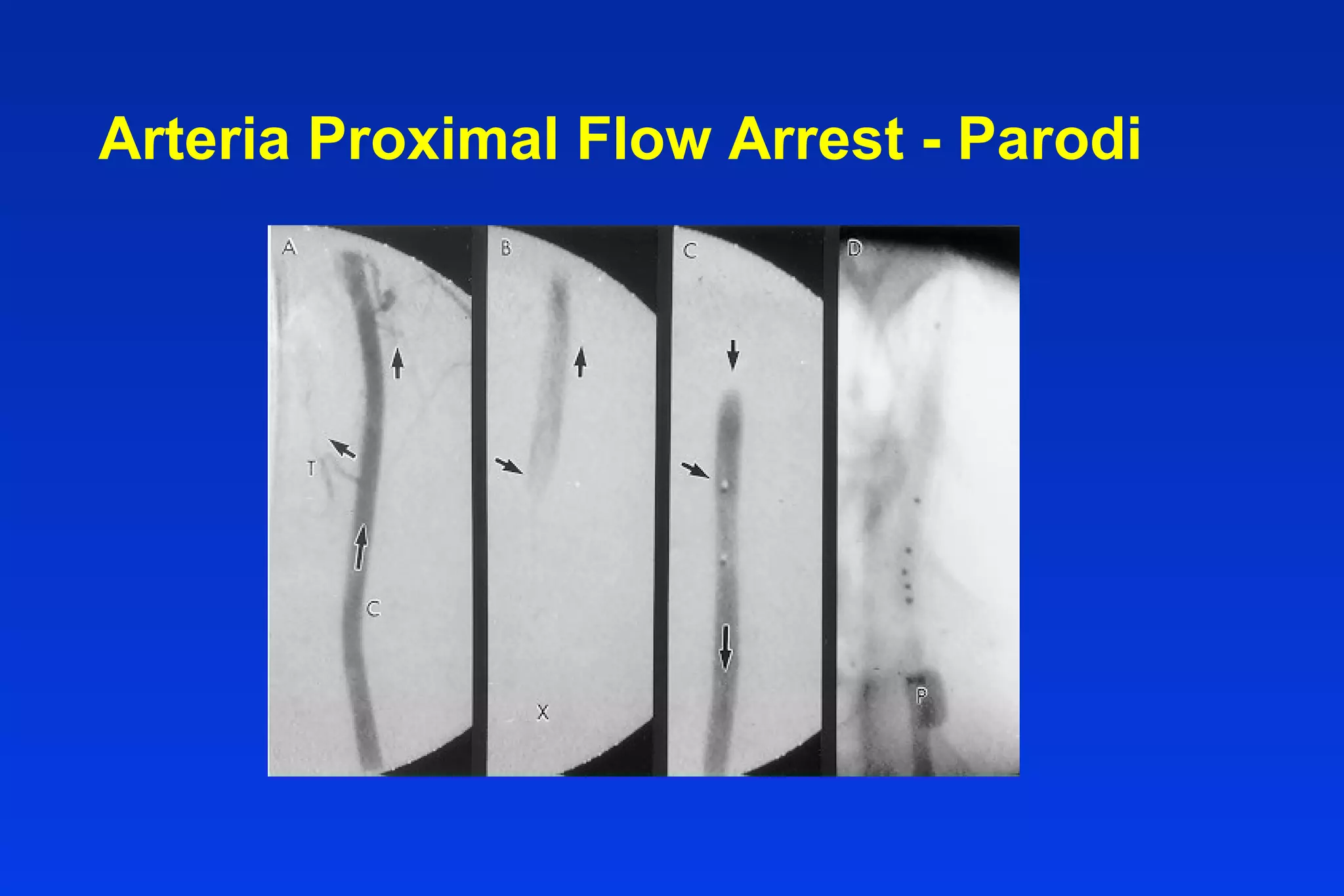 Arteria Proximal Flow Arrest - Parodi
 