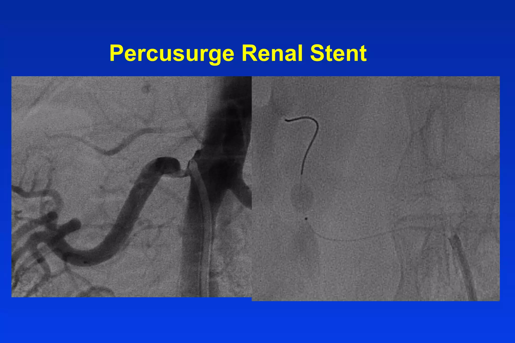 Percusurge Renal Stent
 