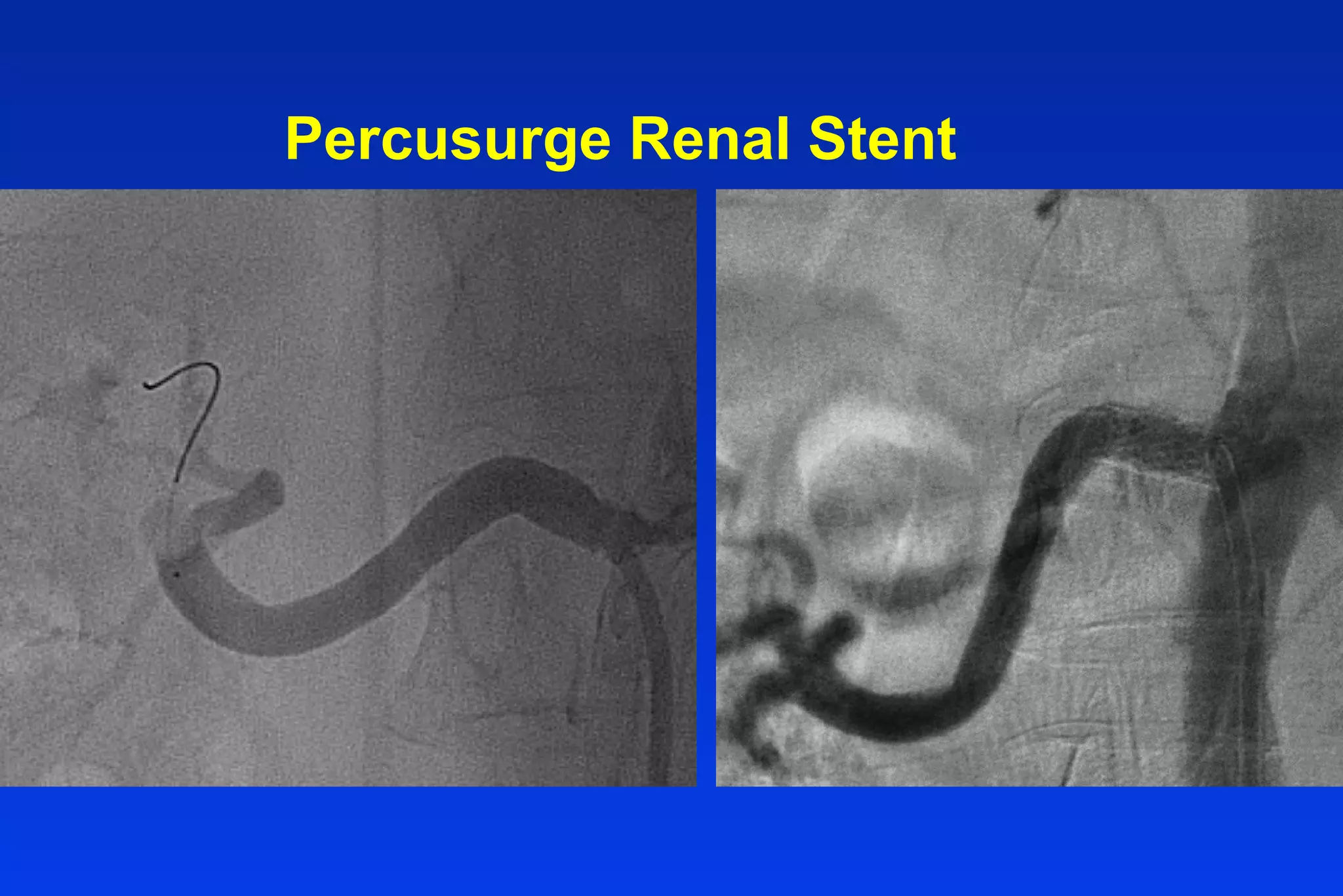 Percusurge Renal Stent
 