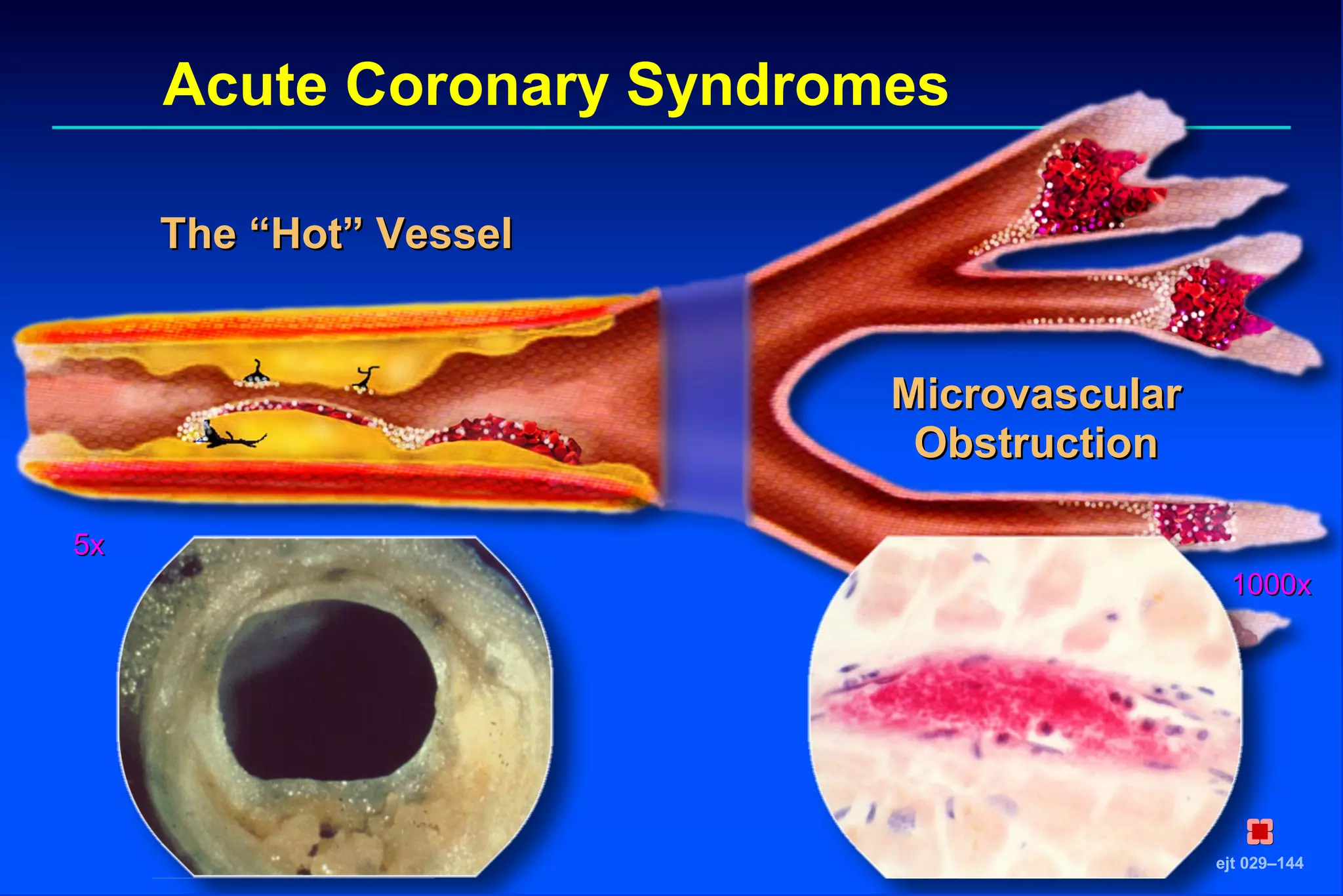 Acute Coronary Syndromes
ejt 029–144
The “Hot” VesselThe “Hot” Vessel
MicrovascularMicrovascular
ObstructionObstruction
1000x1000x
5x5x
 