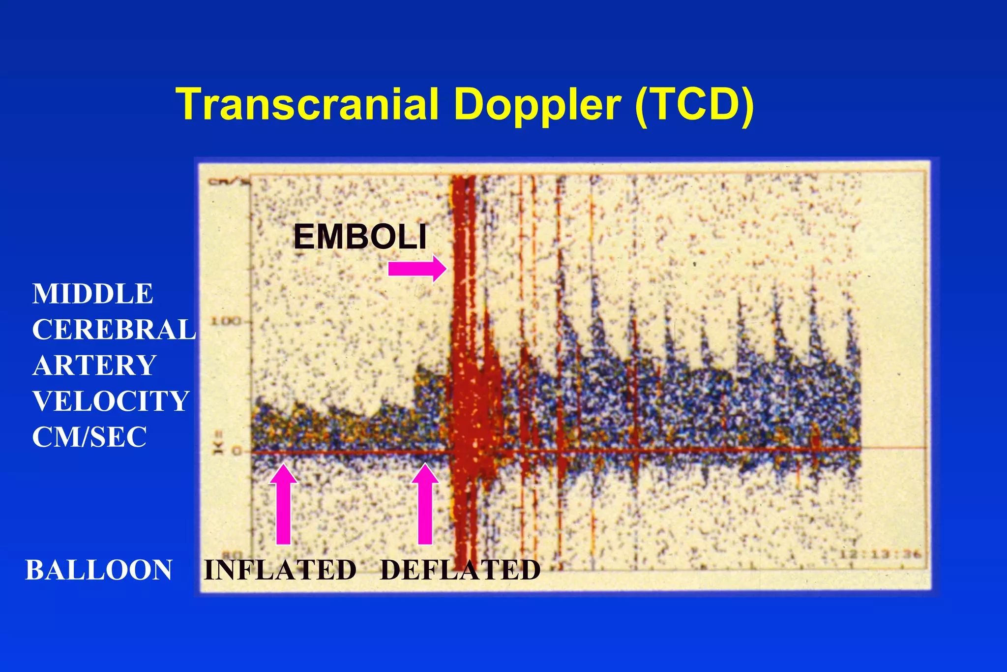 Transcranial Doppler (TCD)
MIDDLE
CEREBRAL
ARTERY
VELOCITY
CM/SEC
EMBOLI
BALLOON INFLATED DEFLATED
 
