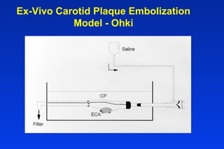 Ex-Vivo Carotid Plaque Embolization
Model - Ohki
 