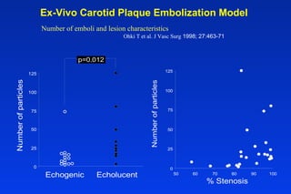 Ex-Vivo Carotid Plaque Embolization Model
Ohki T et al. J Vasc Surg 1998; 27:463-71
Number of emboli and lesion characteristics
Echolucent
0
25
50
75
100
125
Echogenic
Numberofparticles
p=0.012
Numberofparticles
0
25
50
75
100
125
50 60 70 80 90 100
% Stenosis
 