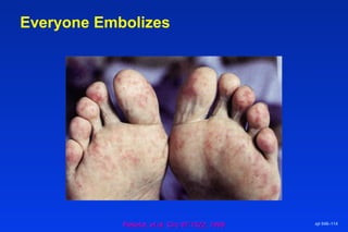 Everyone Embolizes
ejt 048–114
Pettelot, et al. Circ 97:1522, 1998Pettelot, et al. Circ 97:1522, 1998
 