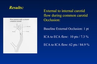 External to internal carotid
flow during common carotid
Occlusion:
Baseline External Occlusion: 1 pt
ICA to ECA flow: 10 pts / 7.3 %
ECA to ICA flow: 62 pts / 84.9 %
Results:
 