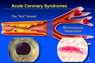 Acute Coronary Syndromes
ejt 029–144
The “Hot” VesselThe “Hot” Vessel
MicrovascularMicrovascular
ObstructionObstruction
1000x1000x
5x5x
 