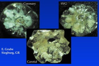 Coronary SVG
Carotid
E. Grube
Siegburg, GR
 