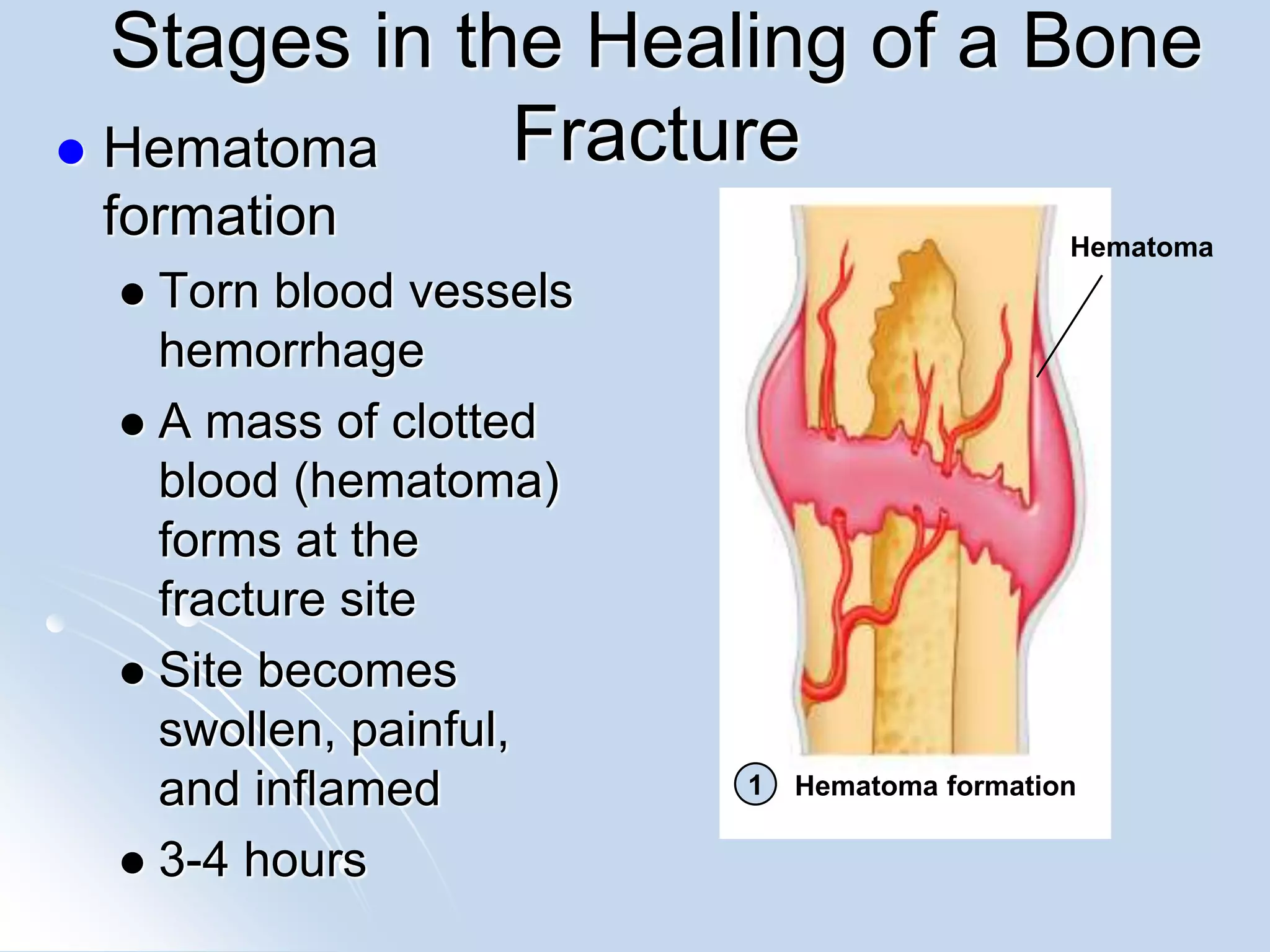 Fracture- its types and process of bone healing. | PPT