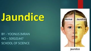 Jaundice
BY - YOONUS IMRAN
NO – 509101447
SCHOOL OF SCIENCE
 