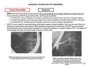 67
SURGICAL PATHOLOGY OF PANCREAS
ERCP has become widely recognized as the most sensitive and reliable method for diagnosi...