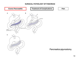 72
SURGICAL PATHOLOGY OF PANCREAS
Cronic Pancreatitis Treatment of Complications Pain
Pancreatico-jejunostomy
 