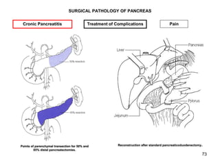 73
SURGICAL PATHOLOGY OF PANCREAS
Cronic Pancreatitis Treatment of Complications Pain
Points of parenchymal transection fo...