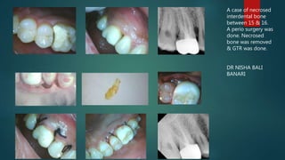 A case of necrosed
interdental bone
between 15 & 16.
A perio surgery was
done. Necrosed
bone was removed
& GTR was done.
DR NISHA BALI
BANARI
 