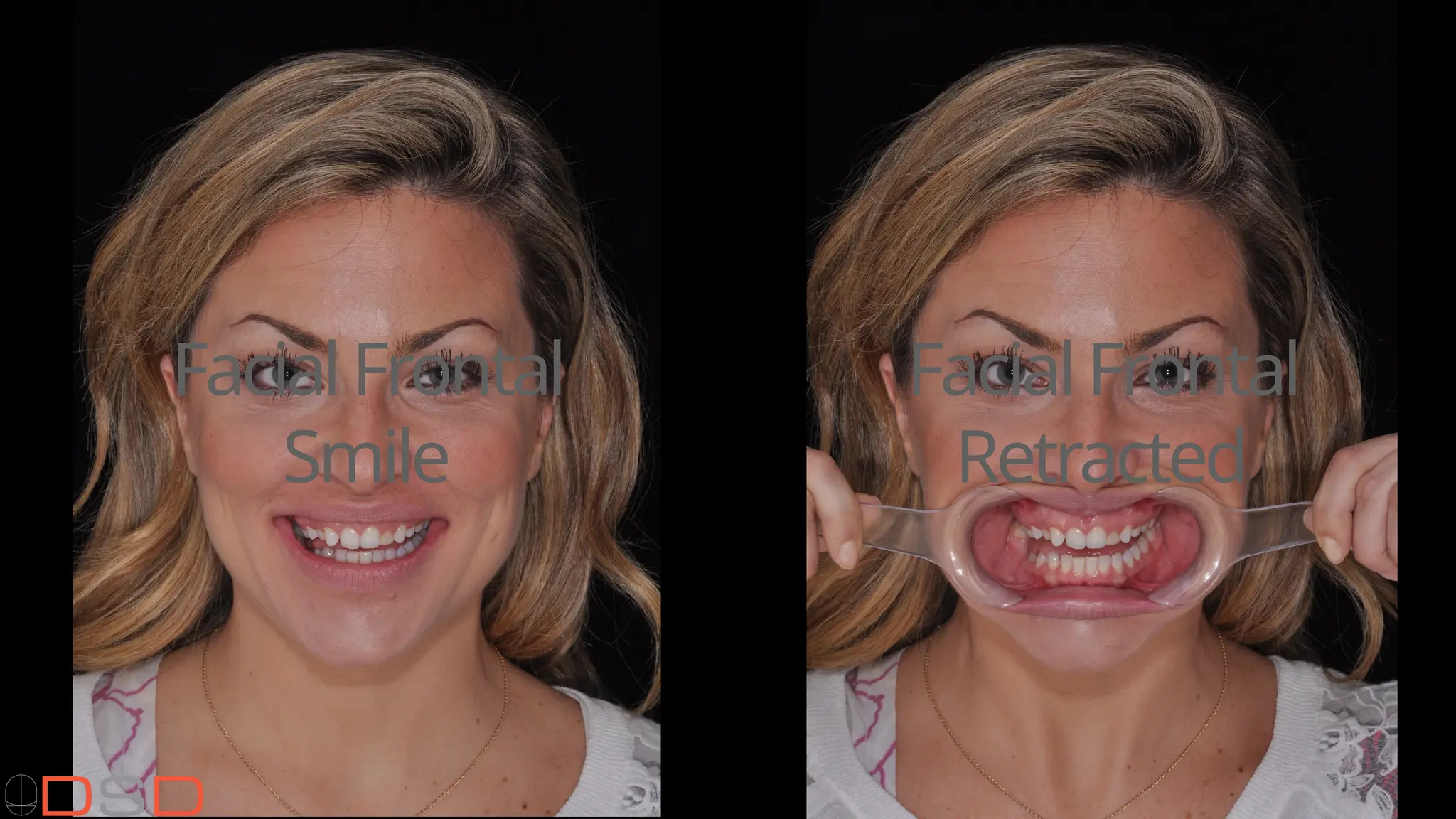 FacialFrontal
Smile
FacialFrontal
Retracted
 