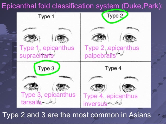 Asian Blepharoplasty Vietnam Version 2013