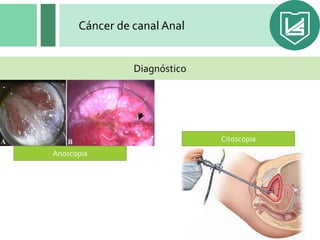 Mulheres coroas gostosas tranzando Cancer anal diagnóstico