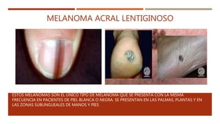 MELANOMA ACRAL LENTIGINOSO
ESTOS MELANOMAS SON EL ÚNICO TIPO DE MELANOMA QUE SE PRESENTA CON LA MISMA
FRECUENCIA EN PACIENTES DE PIEL BLANCA O NEGRA. SE PRESENTAN EN LAS PALMAS, PLANTAS Y EN
LAS ZONAS SUBUNGUEALES DE MANOS Y PIES
 