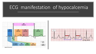 ECG manifestation of hypocalcemia
 