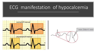 ECG manifestation of hypocalcemia
 