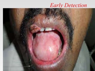 Early Detection
 