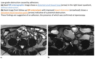 Low-grade obstruction caused by adhesions. 
(a) Axial MR enterographic image shows a distorted small-bowel loop (arrow) in the right lower quadrant, 
without obstruction. 
(b) Axial image from follow-up MR enteroclysis with improved bowel distention (arrowhead) shows a 
persistent focal transition point (arrow) indicative of a proximal obstruction. 
These findings are suggestive of an adhesion, the presence of which was confirmed at laparoscopy. 
 