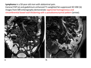 Lymphoma in a 50-year-old man with abdominal pain. 
Coronal FISP (a) and gadolinium-enhanced T1-weighted fat-suppressed 3D VIBE (b) 
images from MR enterography demonstrate segmental homogeneous and 
circumferential bowel wall thickening with a pseudoaneurysmal pattern (arrow). 
 